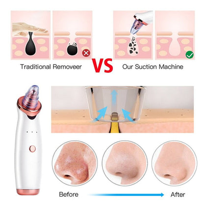 PoreVac Blackhead Remover